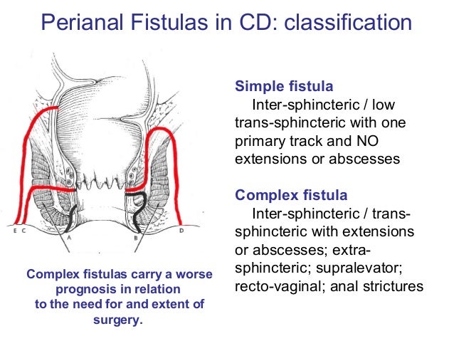 complex anal fistula Complex anal fistula